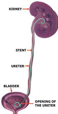 What types of stents are used with kidney stones?