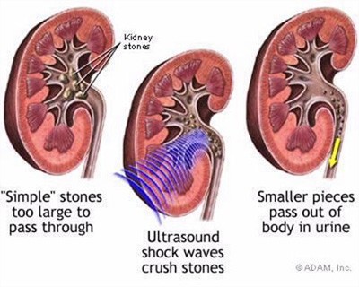 Extracorporeal Shock Wave Lithotripsy (ESWL)