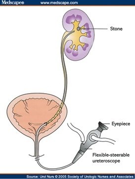 Laser Stone Surgery using Flexible Pyeloscopy