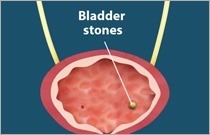Bladder Stones