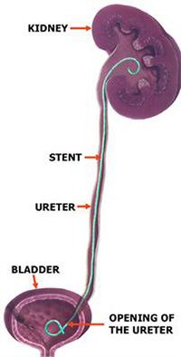 Image result for double j stent