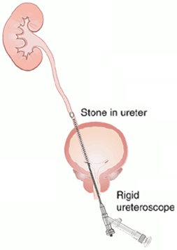 Laser Stone Surgery using Rigid Ureteroscopy